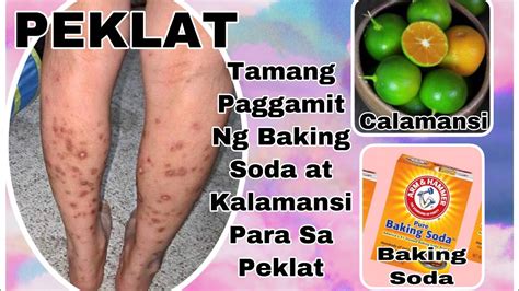 Goodbye peklat! Paano iwasan ang peklat sa balat ng .